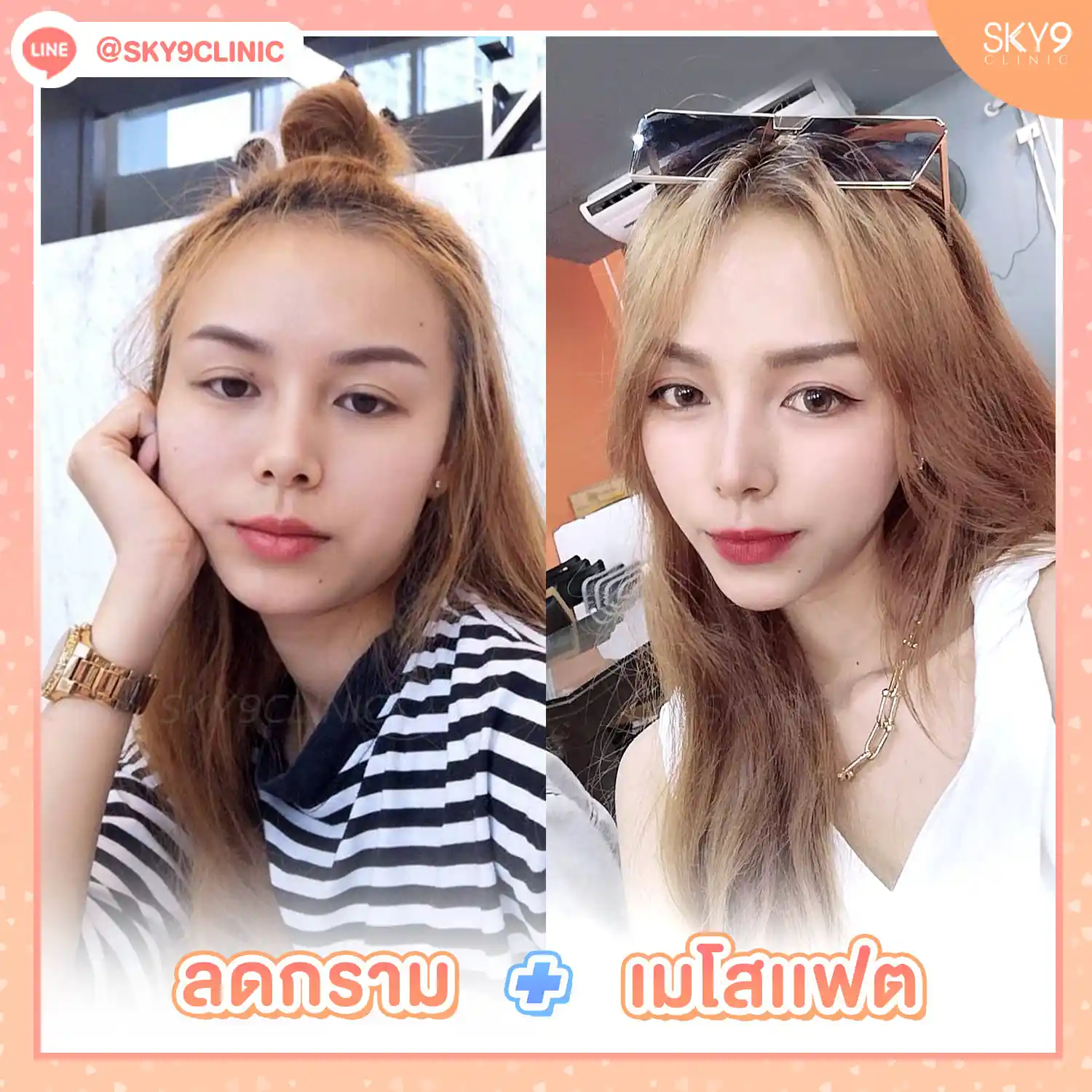 โบท็อกซ์ 02
