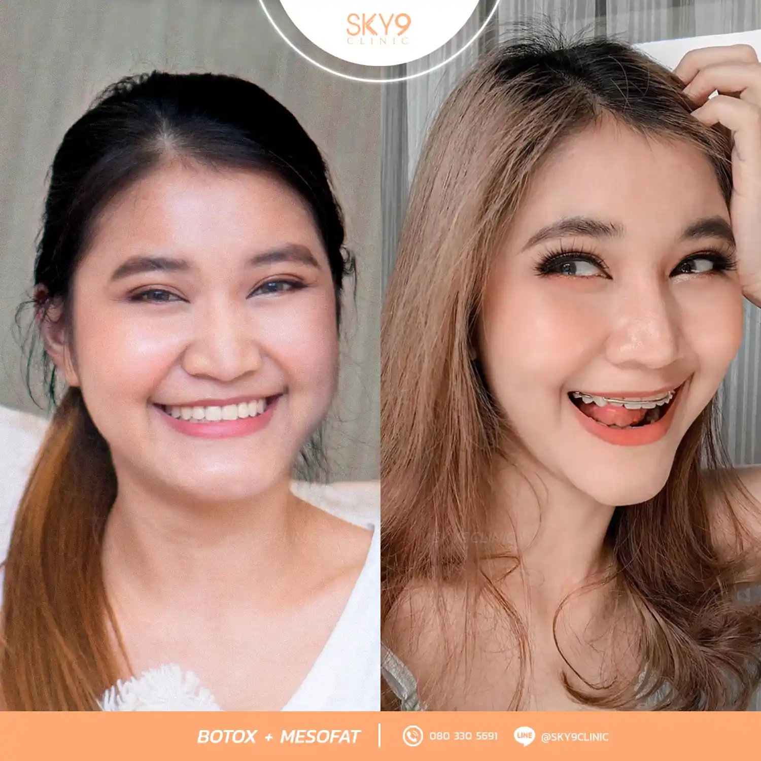 โบท็อกซ์ 04