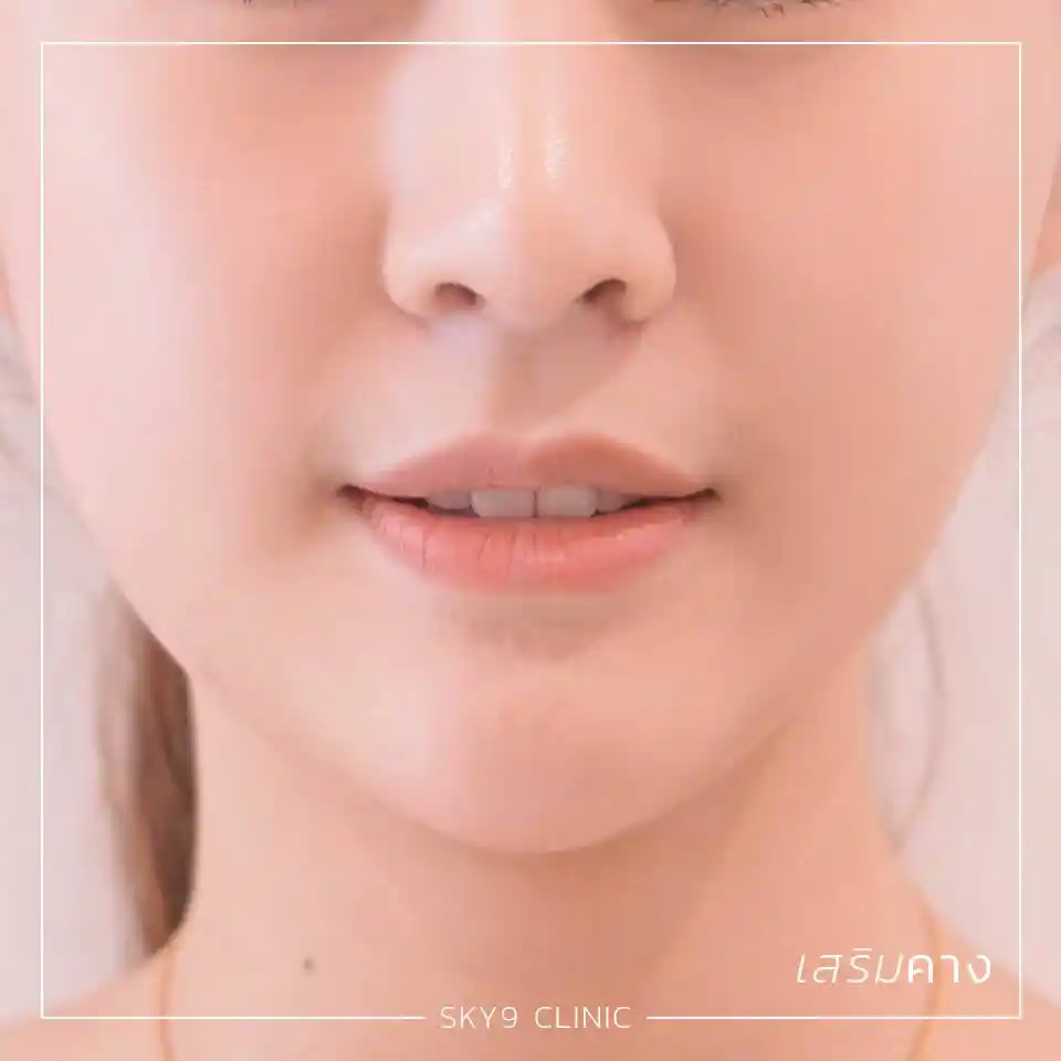 ศัลยกรรมคาง 03