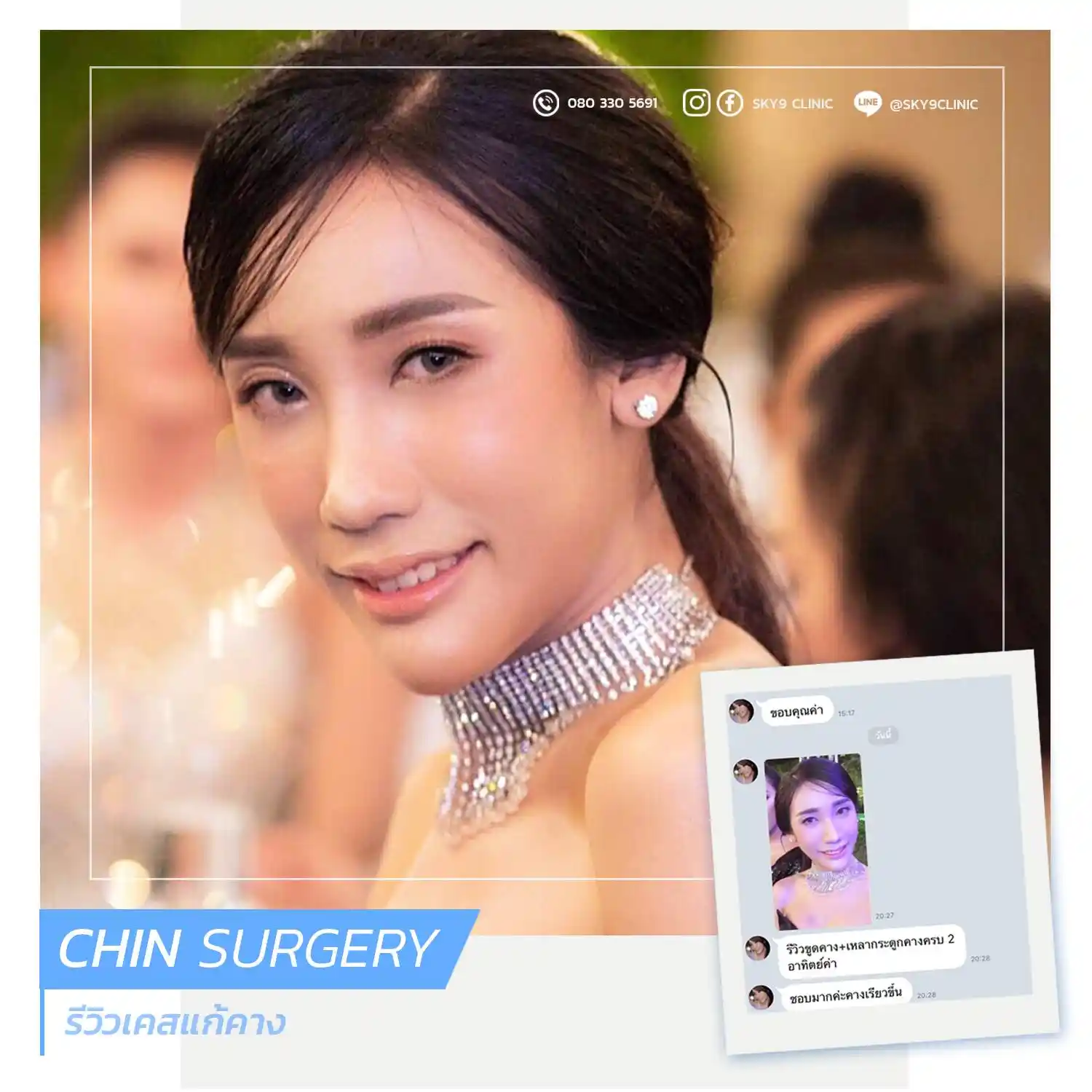ศัลยกรรมคาง 08