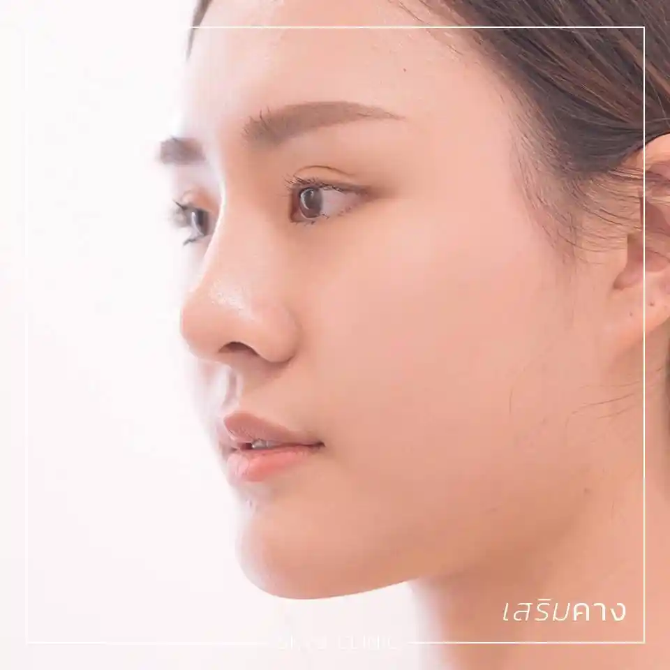 ศัลยกรรมคาง 13