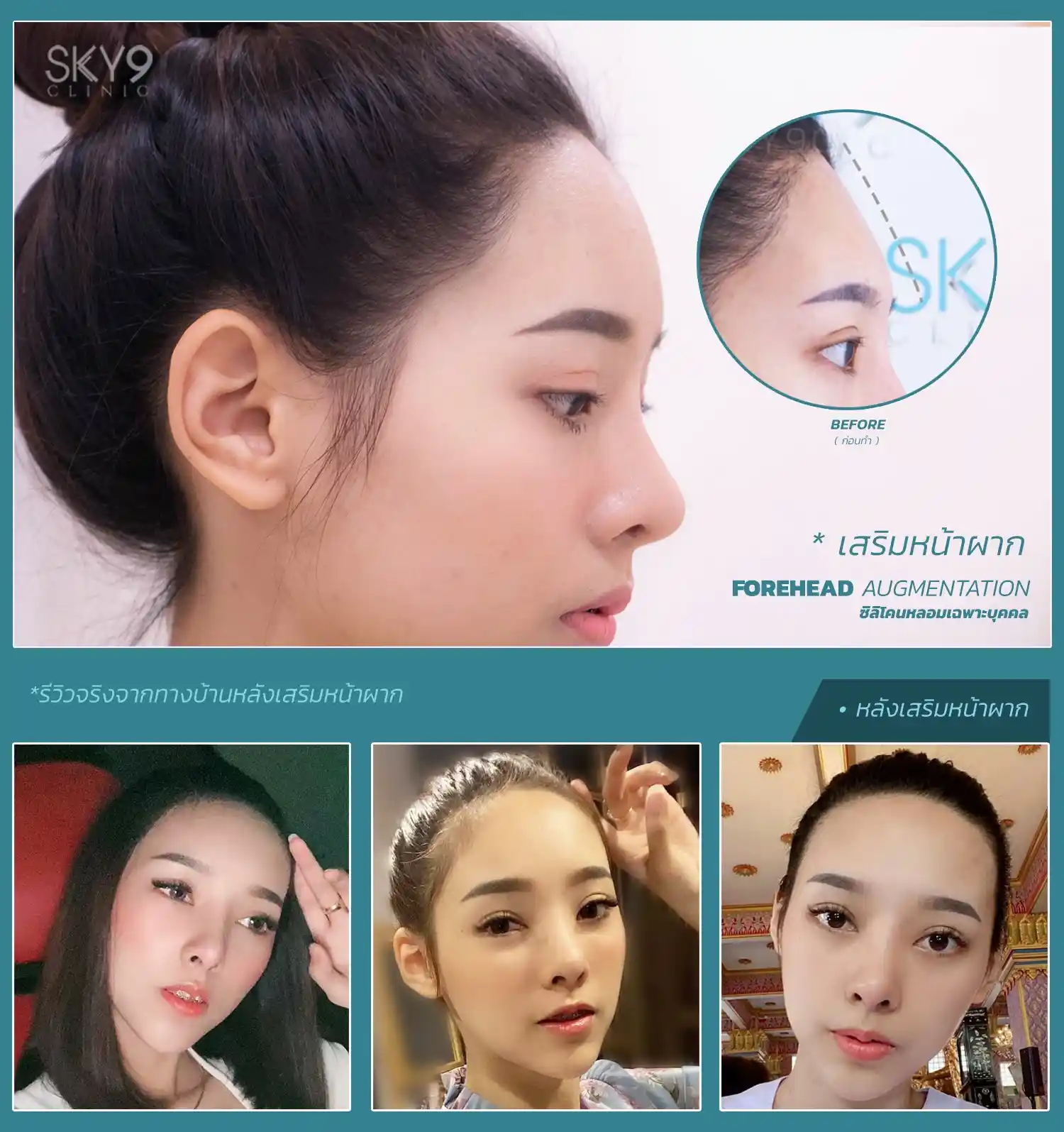 ศัลยกรรมหน้าผาก 03