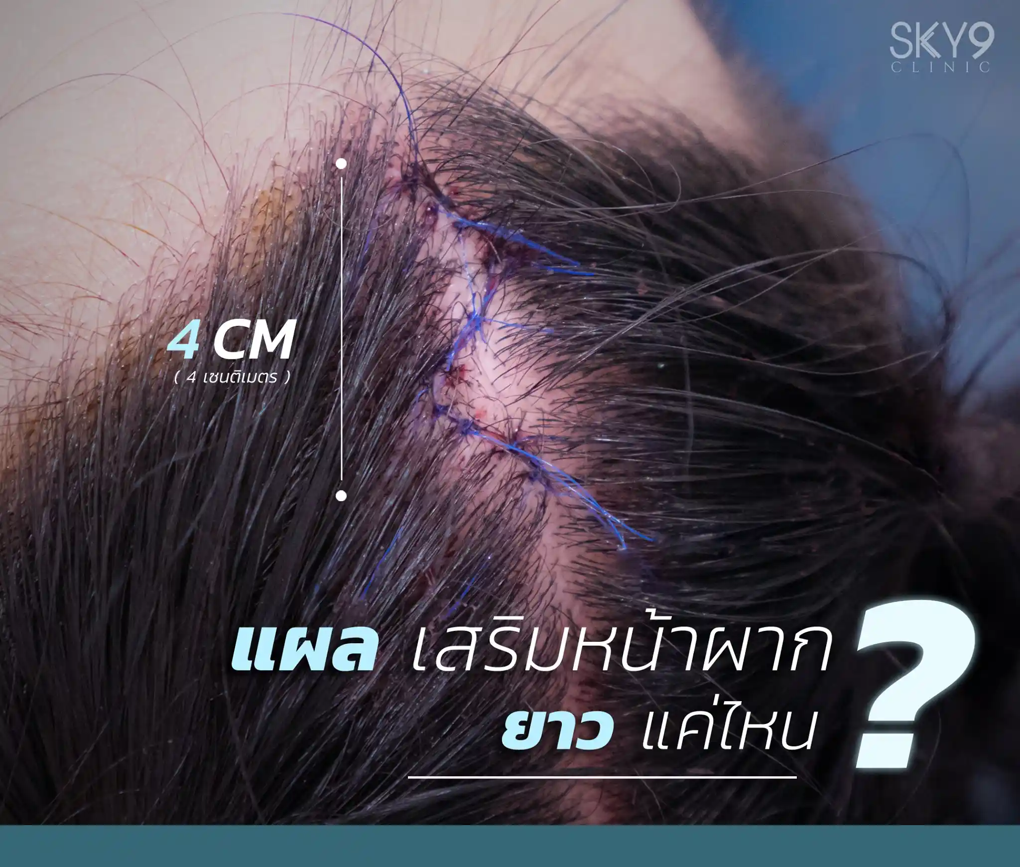 ศัลยกรรมหน้าผาก 07
