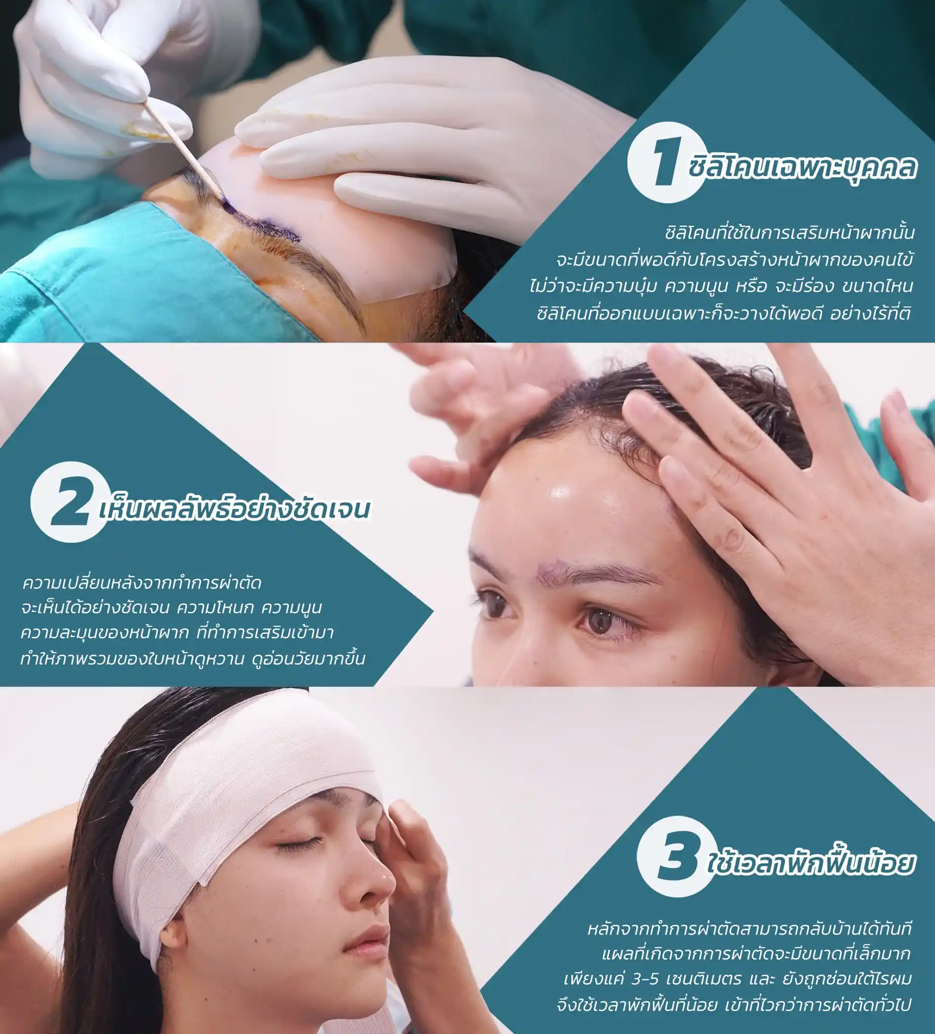 ศัลยกรรมหน้าผาก 08