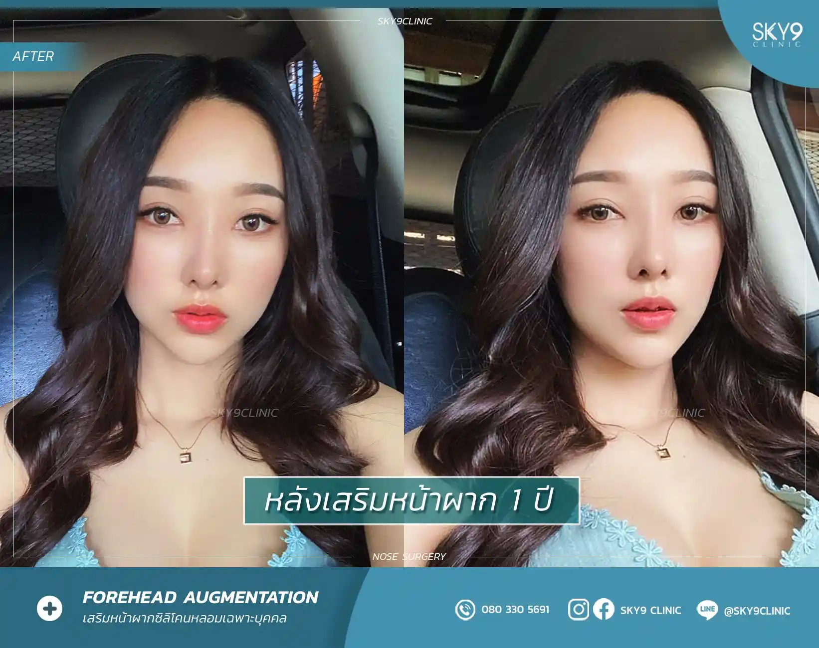 ศัลยกรรมหน้าผาก 12