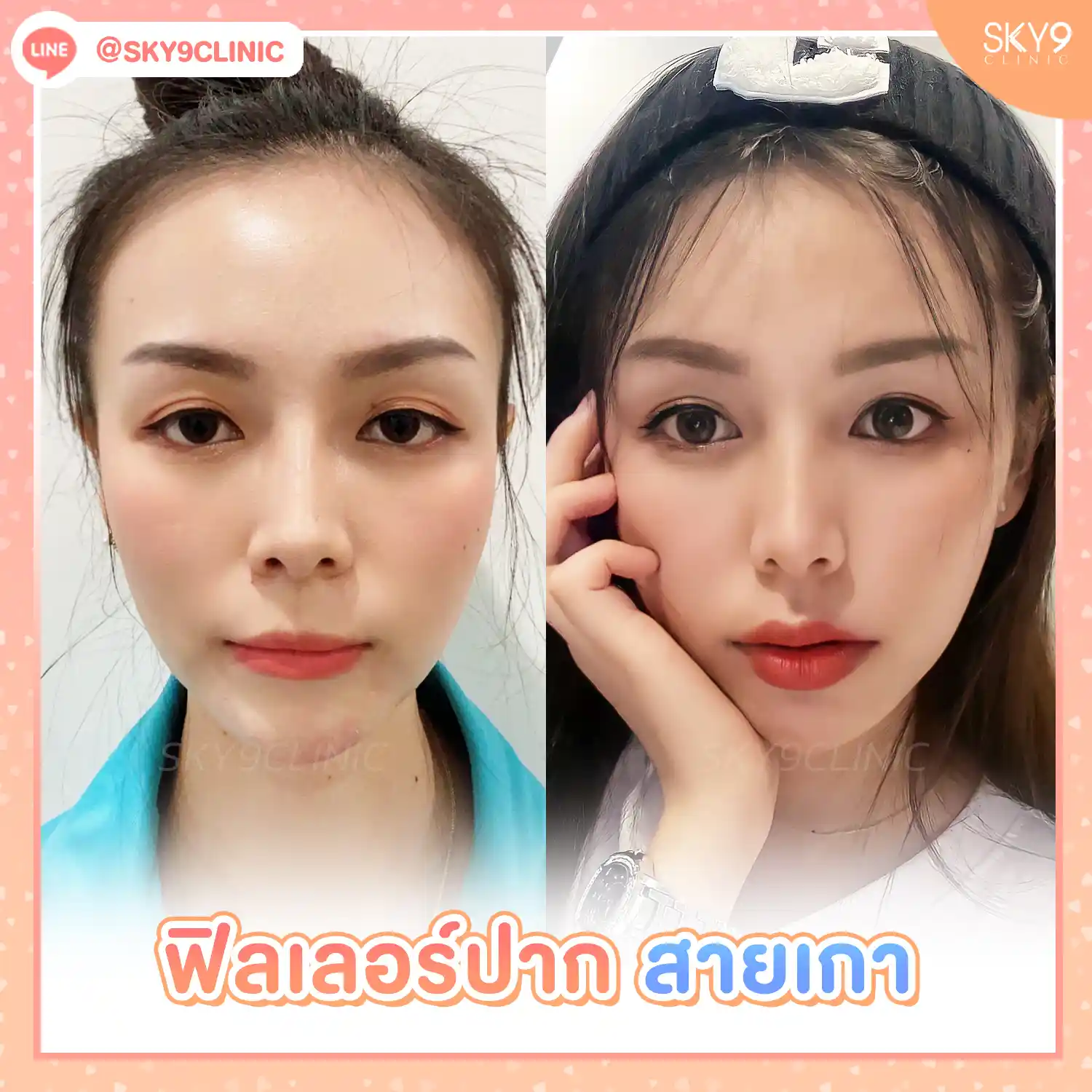 ฟิลเลอร์ปาก 04
