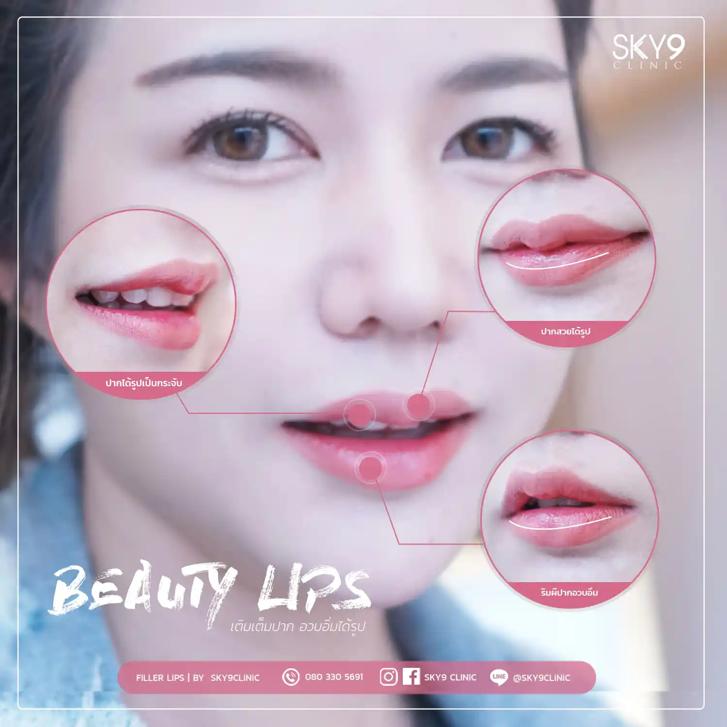 ฟิลเลอร์ปาก 05
