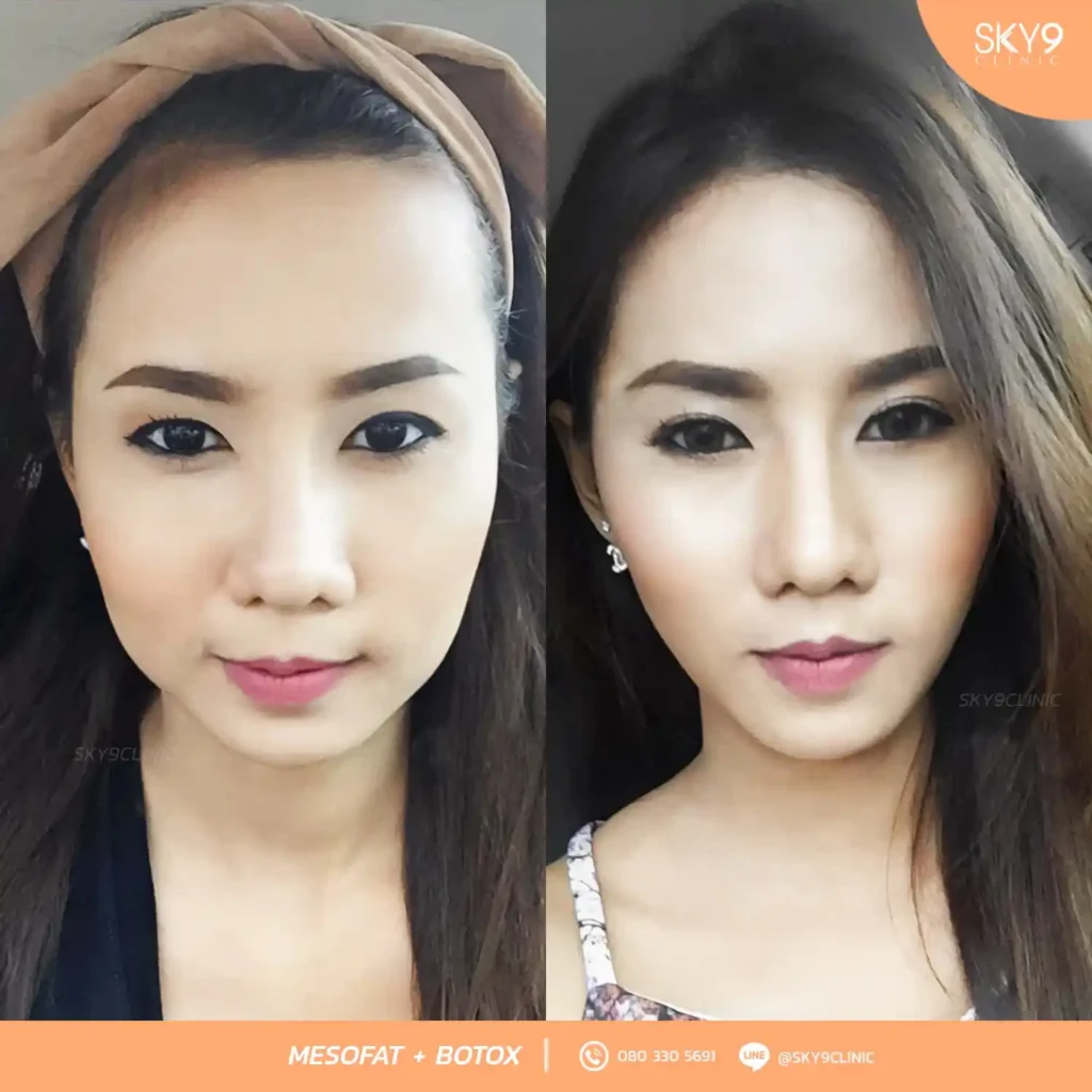 เมโสแฟต 03