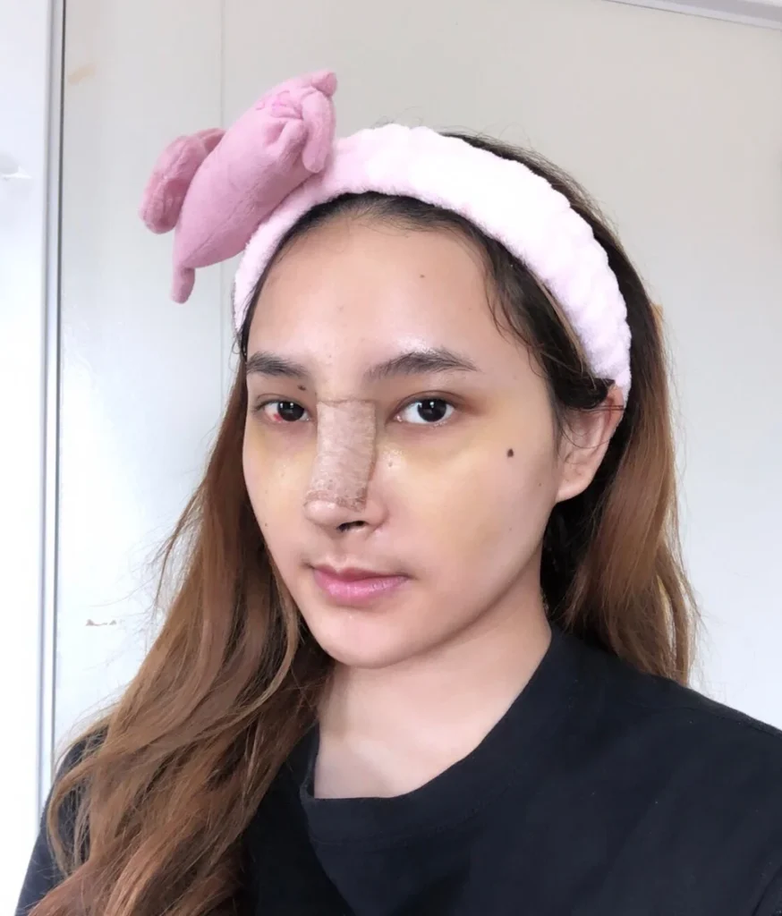 ผลลัพธ์หลังเสริมจมูก 01