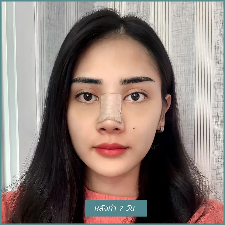 หลังเสริมจมูก 02
