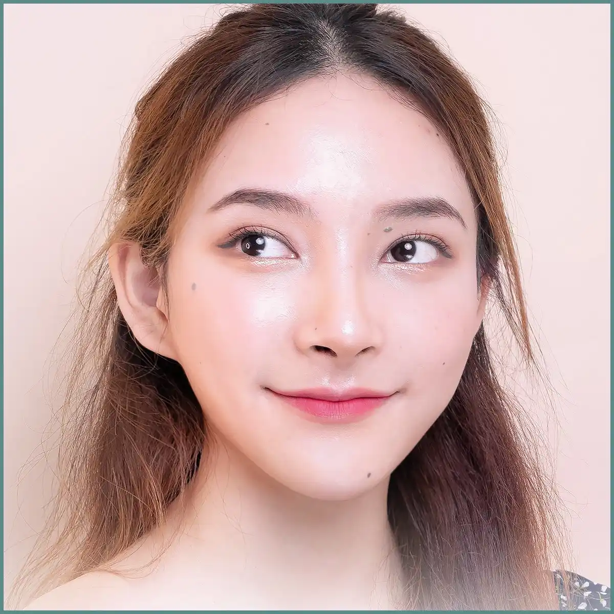 ผลลัพธ์หลังเสริมจมูก 02
