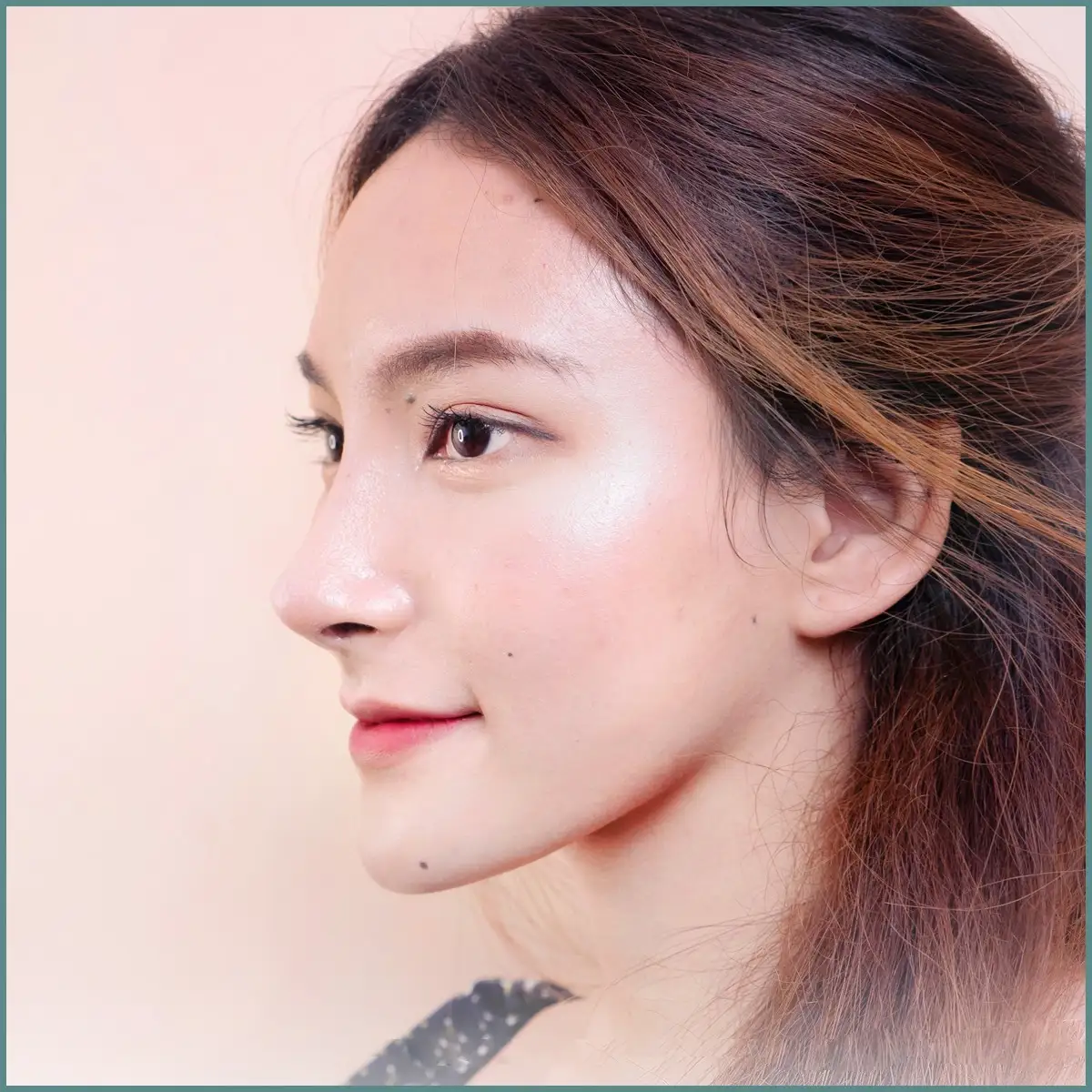 ผลลัพธ์หลังเสริมจมูก 03