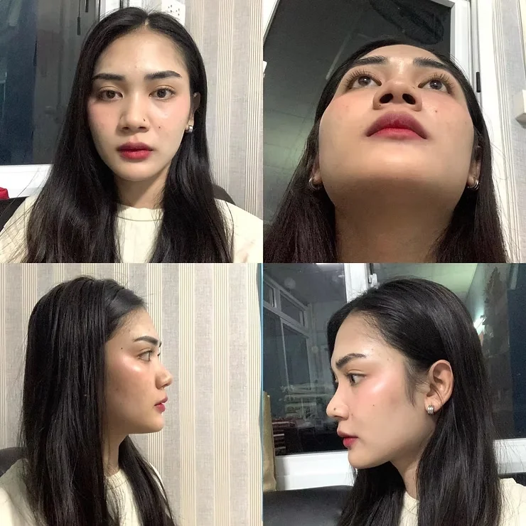 ก่อน-หลังเสริมจมูก 03