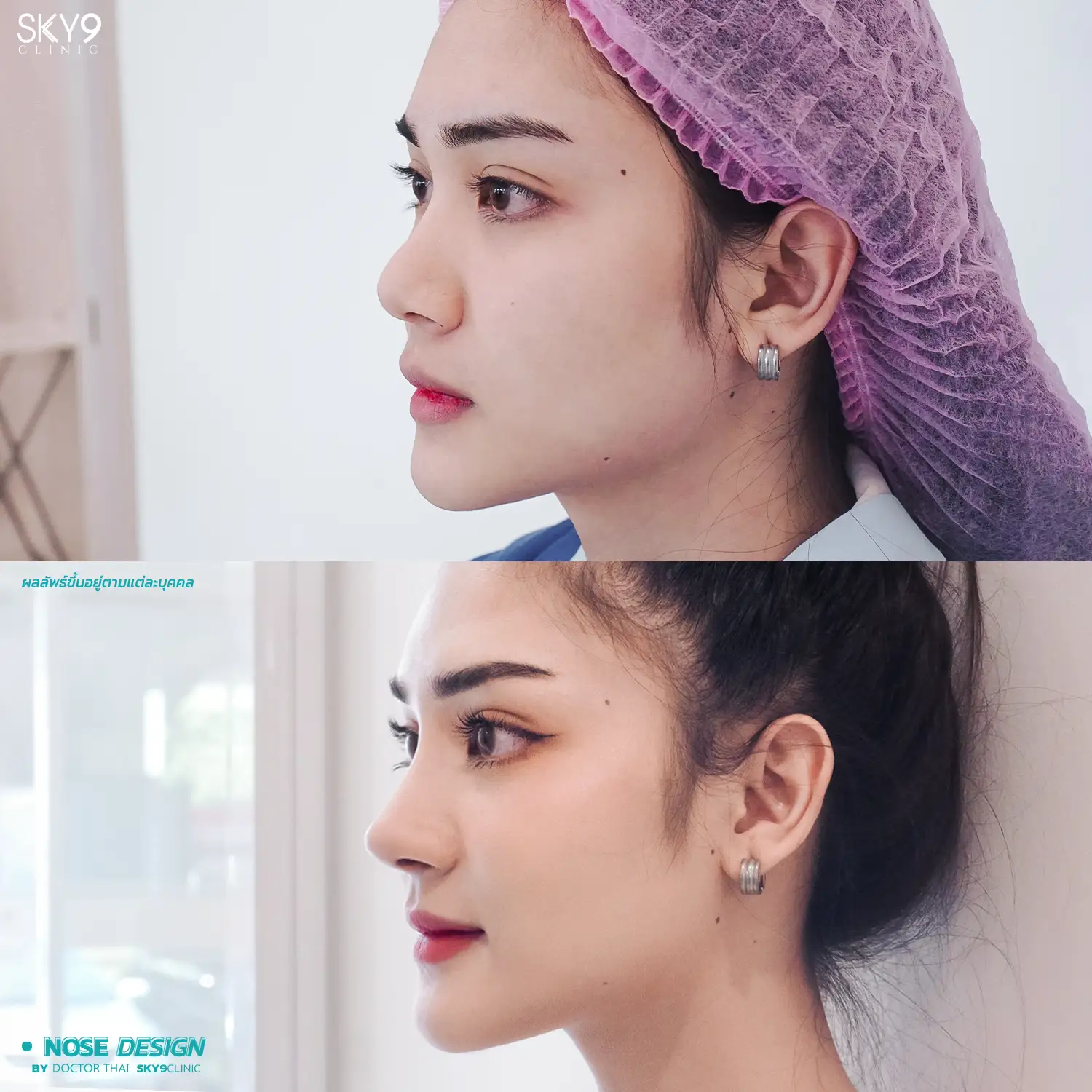 ก่อน-หลังเสริมจมูก 01