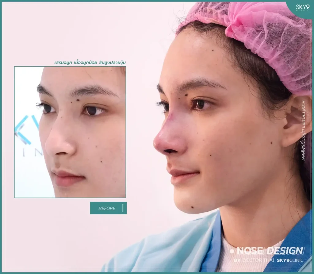 profile.webpภาพเปรียบเทียบก่อนและหลังเสริมจมูก