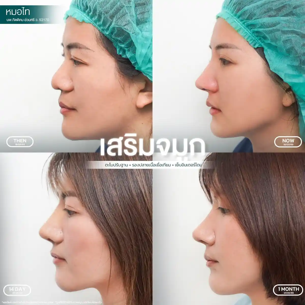 รีวิวเสริมจมูก 01