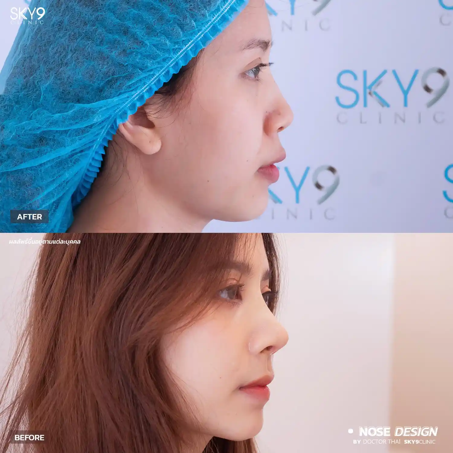 รีวิวเสริมจมูก 15