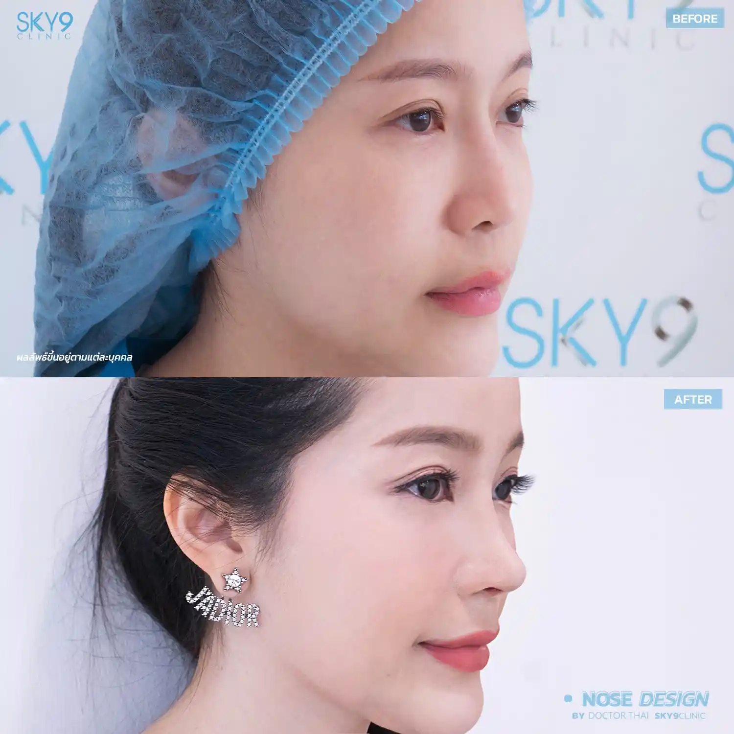 รีวิวเสริมจมูก 18