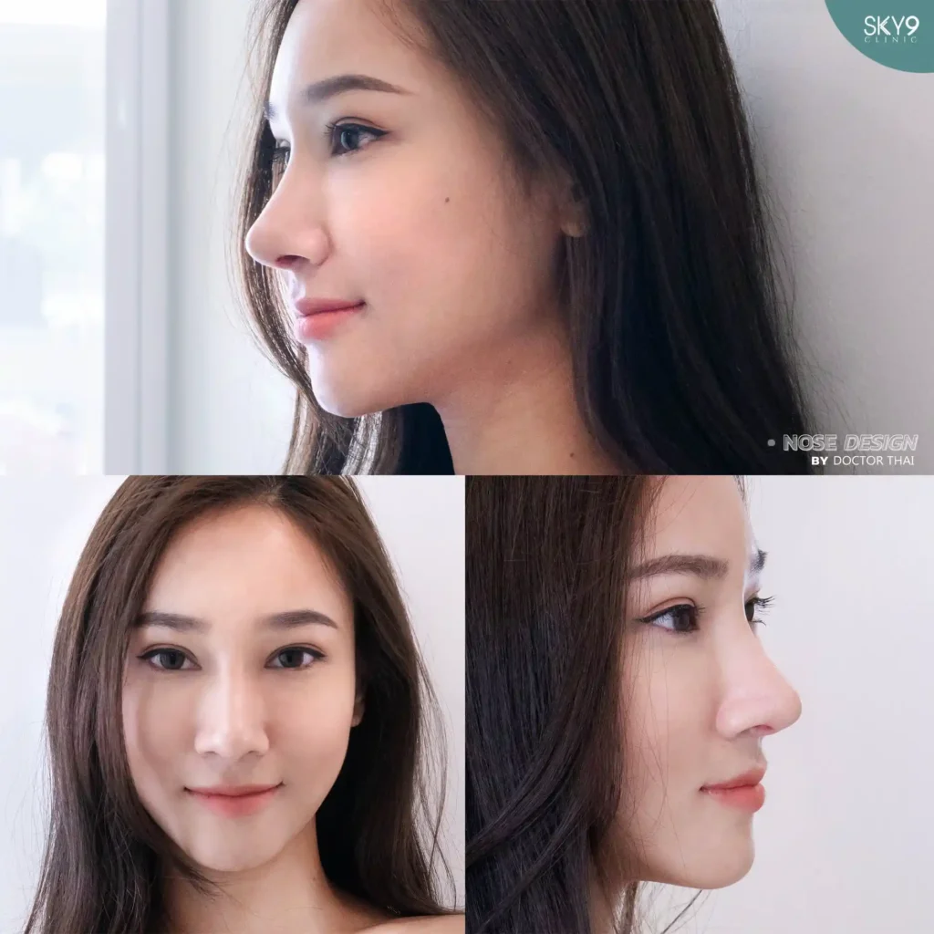 รีวิวเสริมจมูก 25