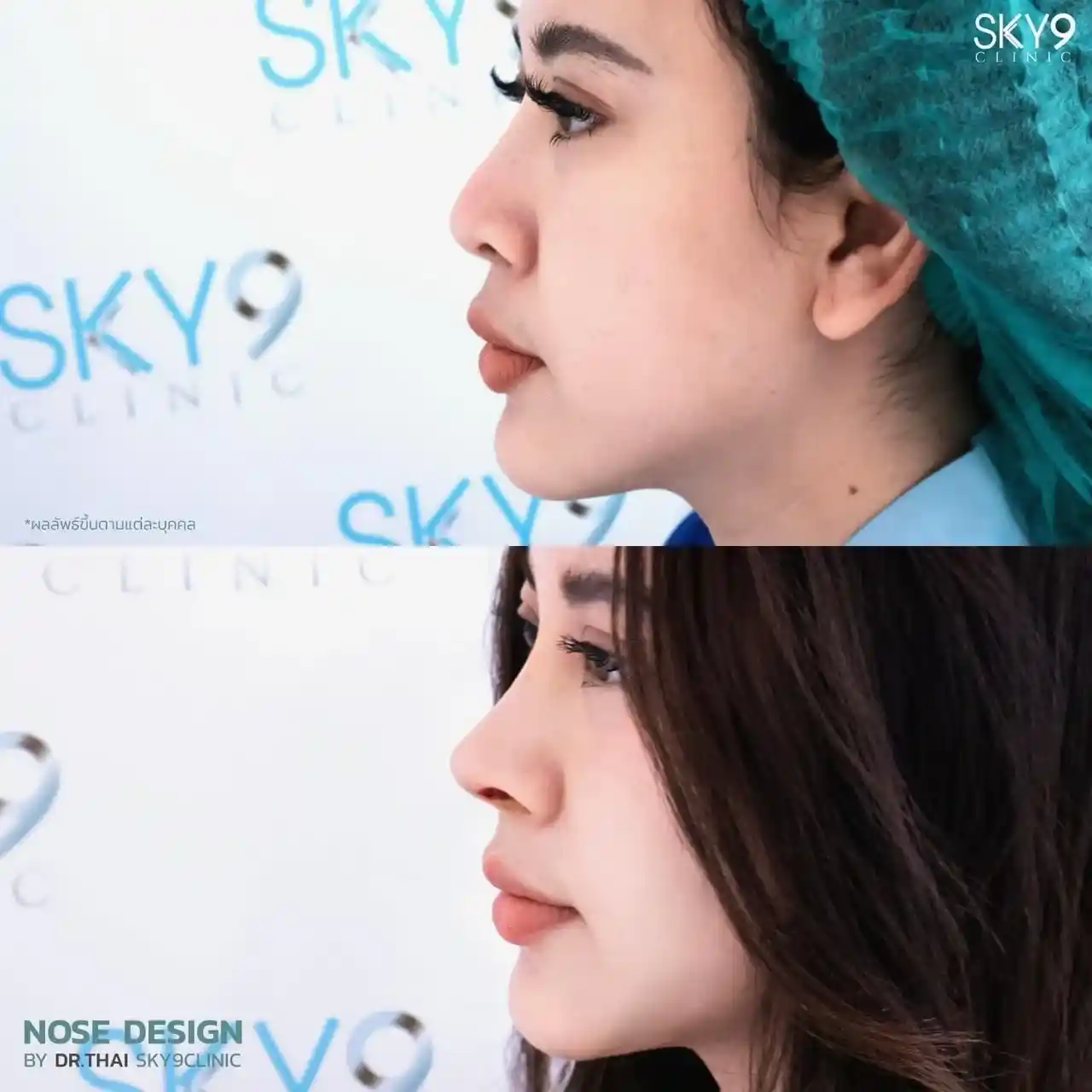 รีวิวเสริมจมูก 30