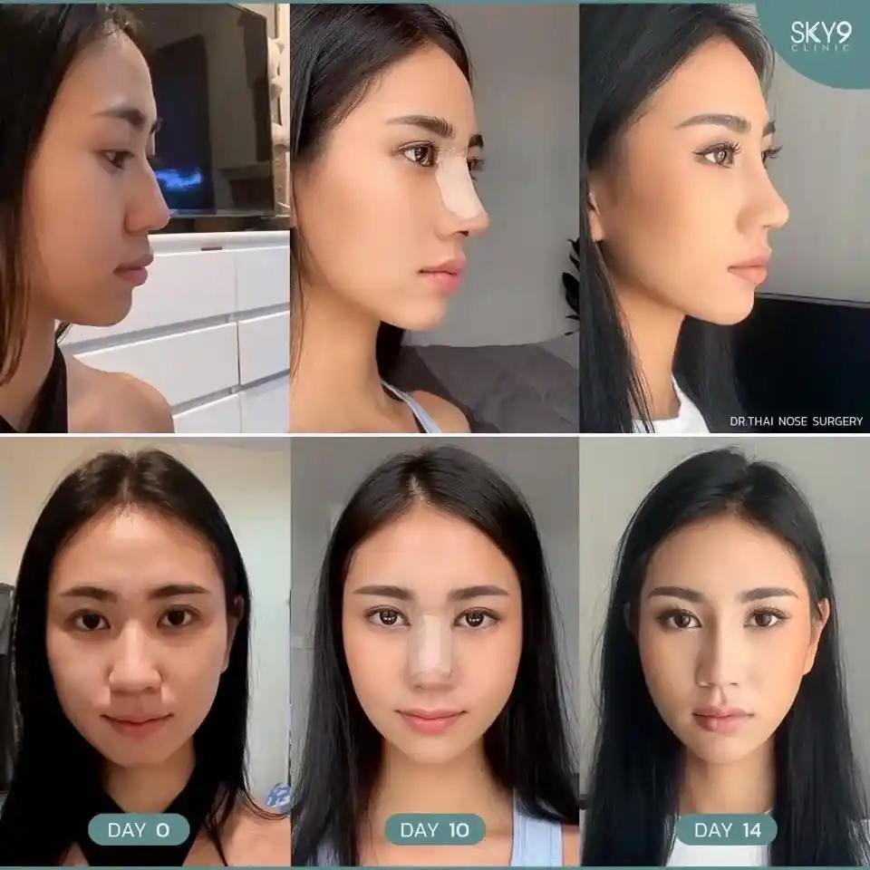 รีวิวเสริมจมูก 31
