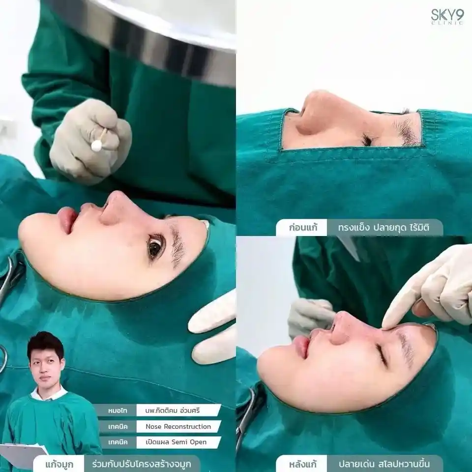 รีวิวเสริมจมูก 32