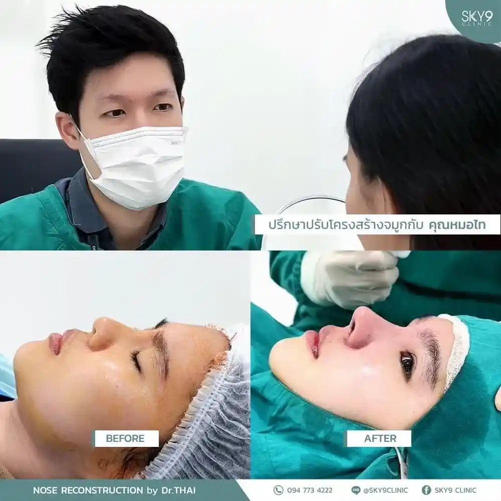 รีวิวเสริมจมูก 33