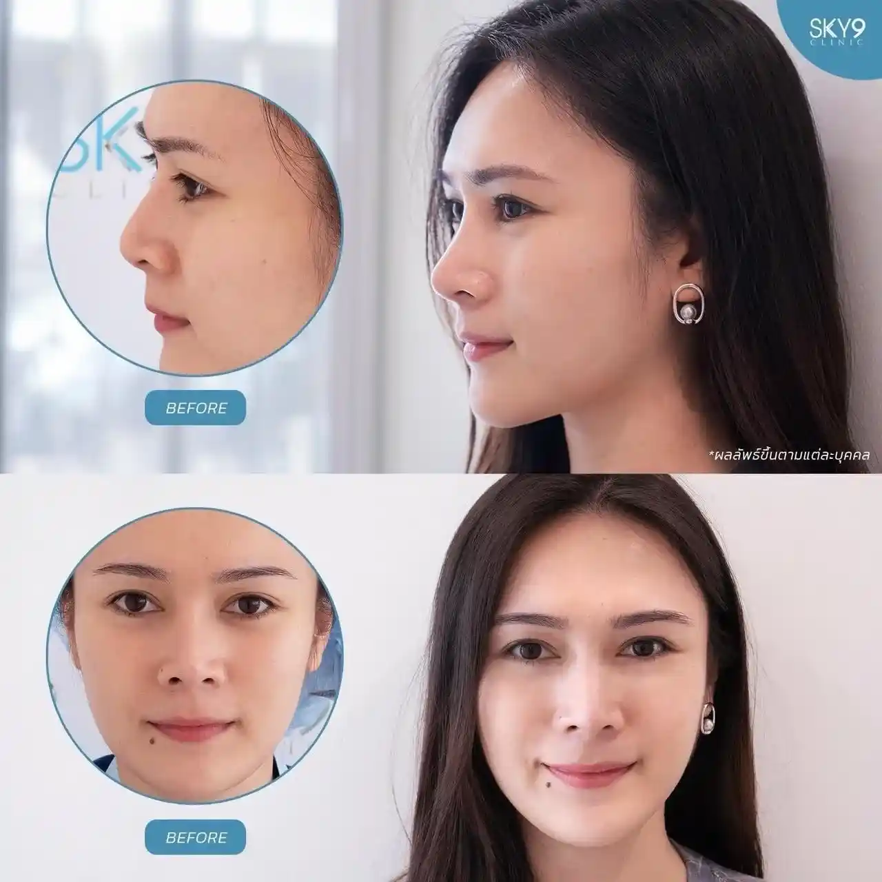 รีวิวเสริมจมูก 34