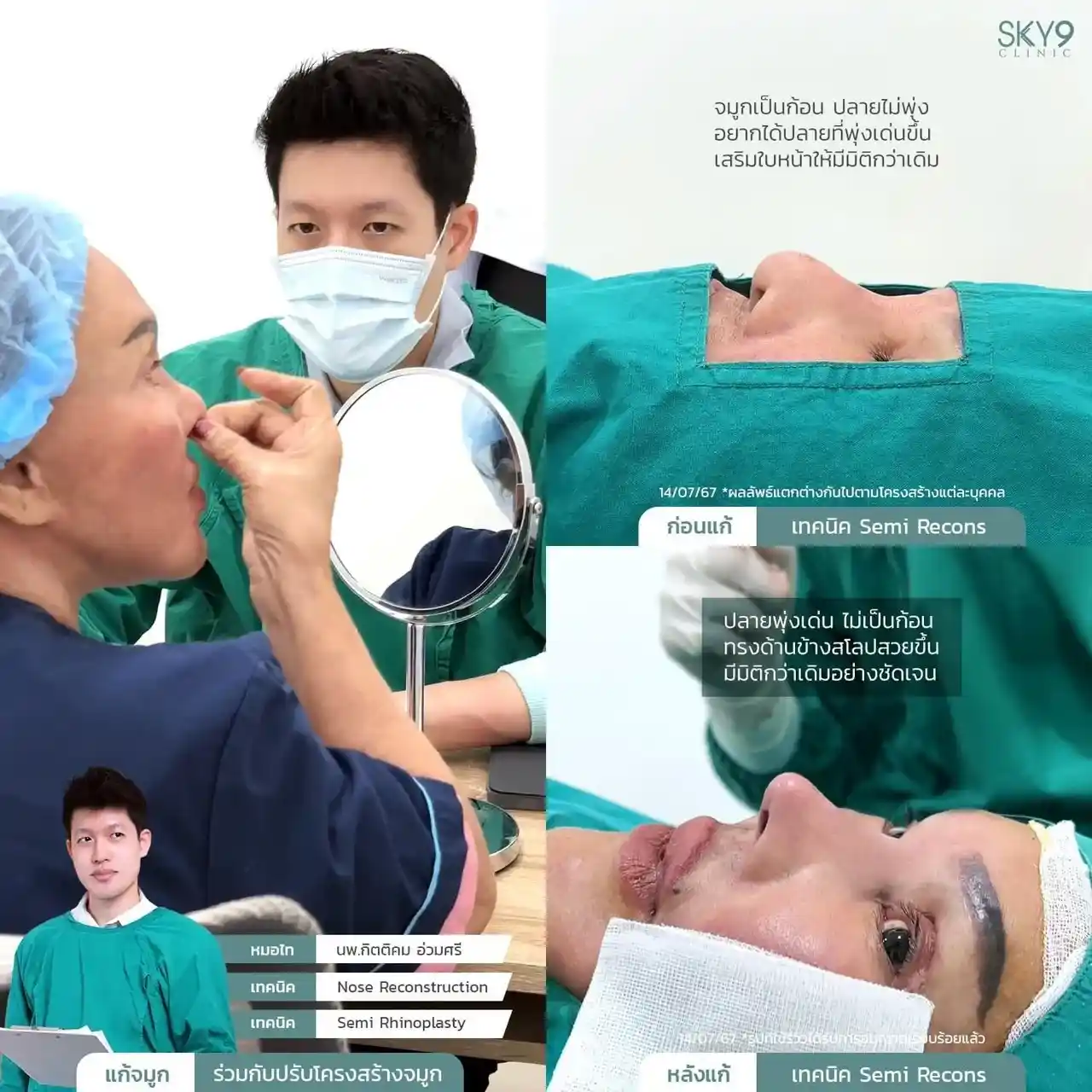 รีวิวเสริมจมูก 36