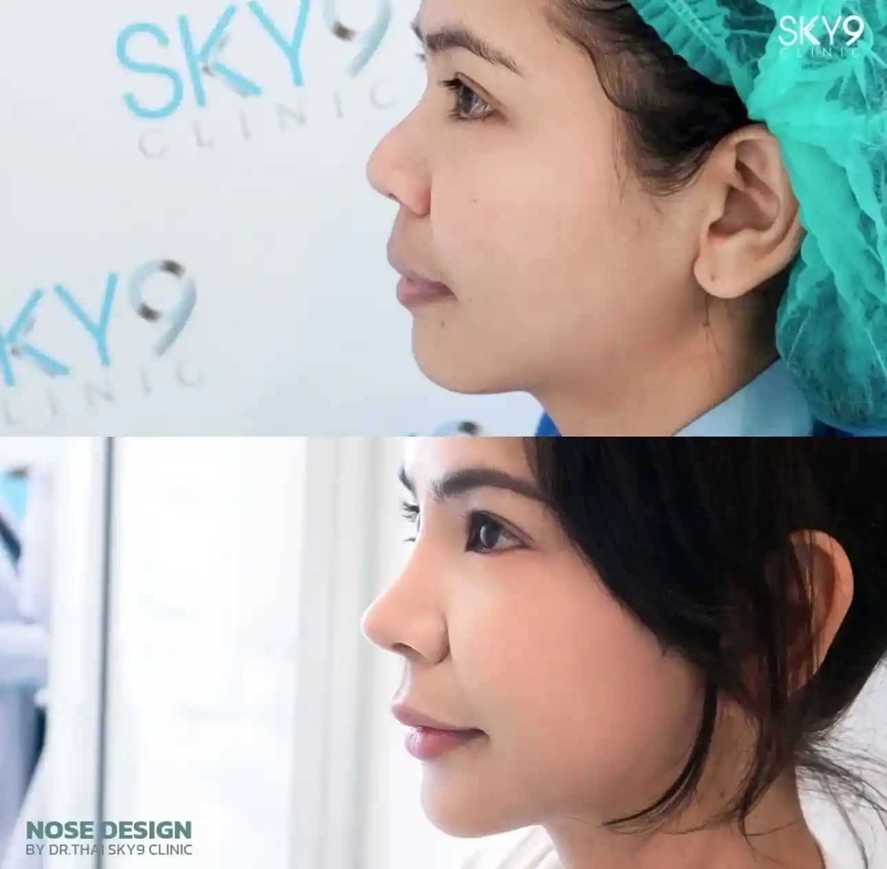 รีวิวเสริมจมูก 37