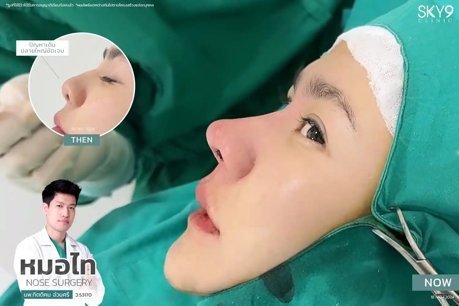 รีวิวเสริมจมูก 48