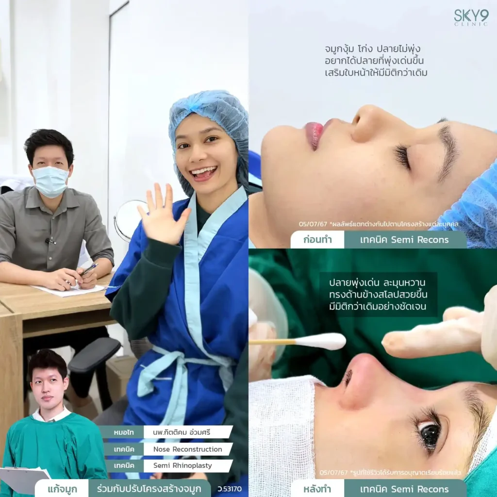 รีวิวเสริมจมูก 49