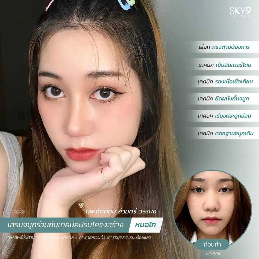รีวิวเสริมจมูก 50