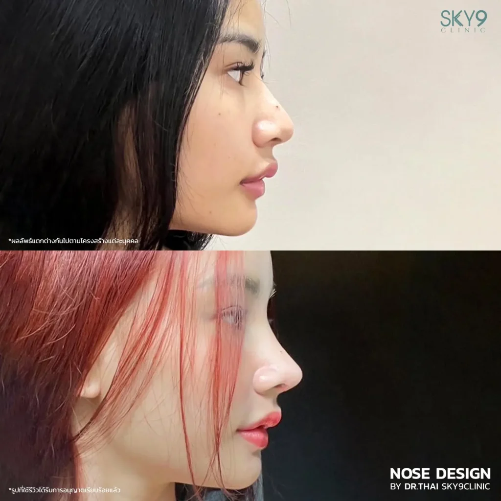 รีวิวเสริมจมูก 51