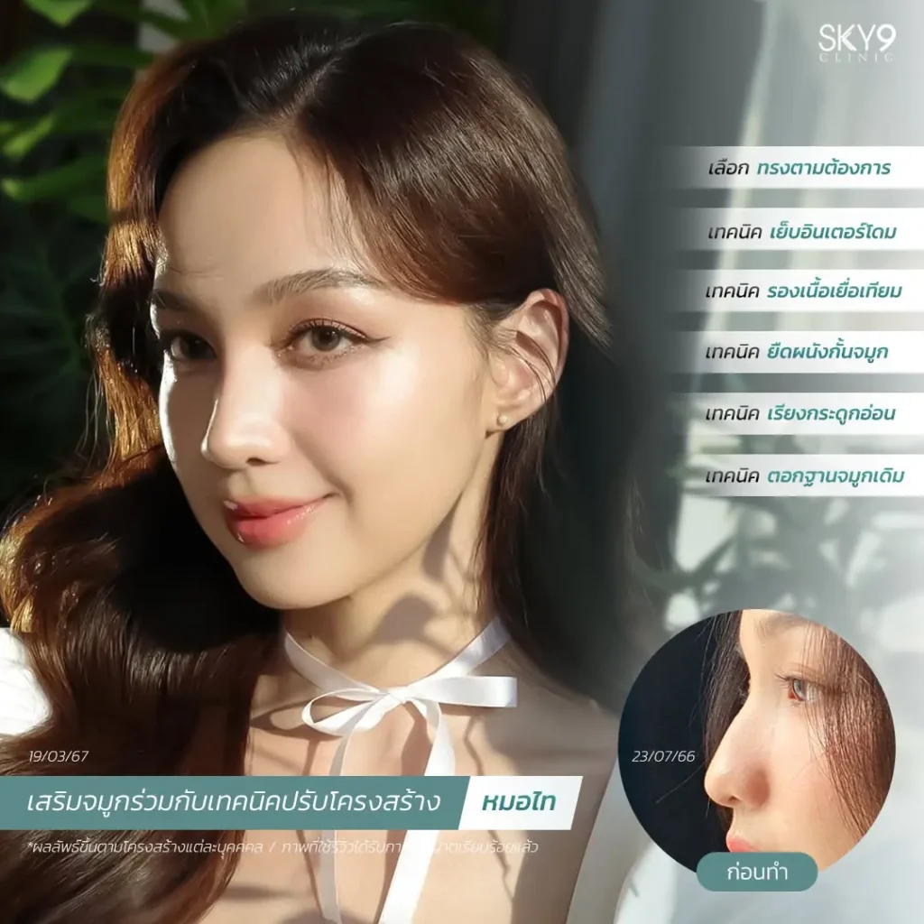 รีวิวเสริมจมูก 52