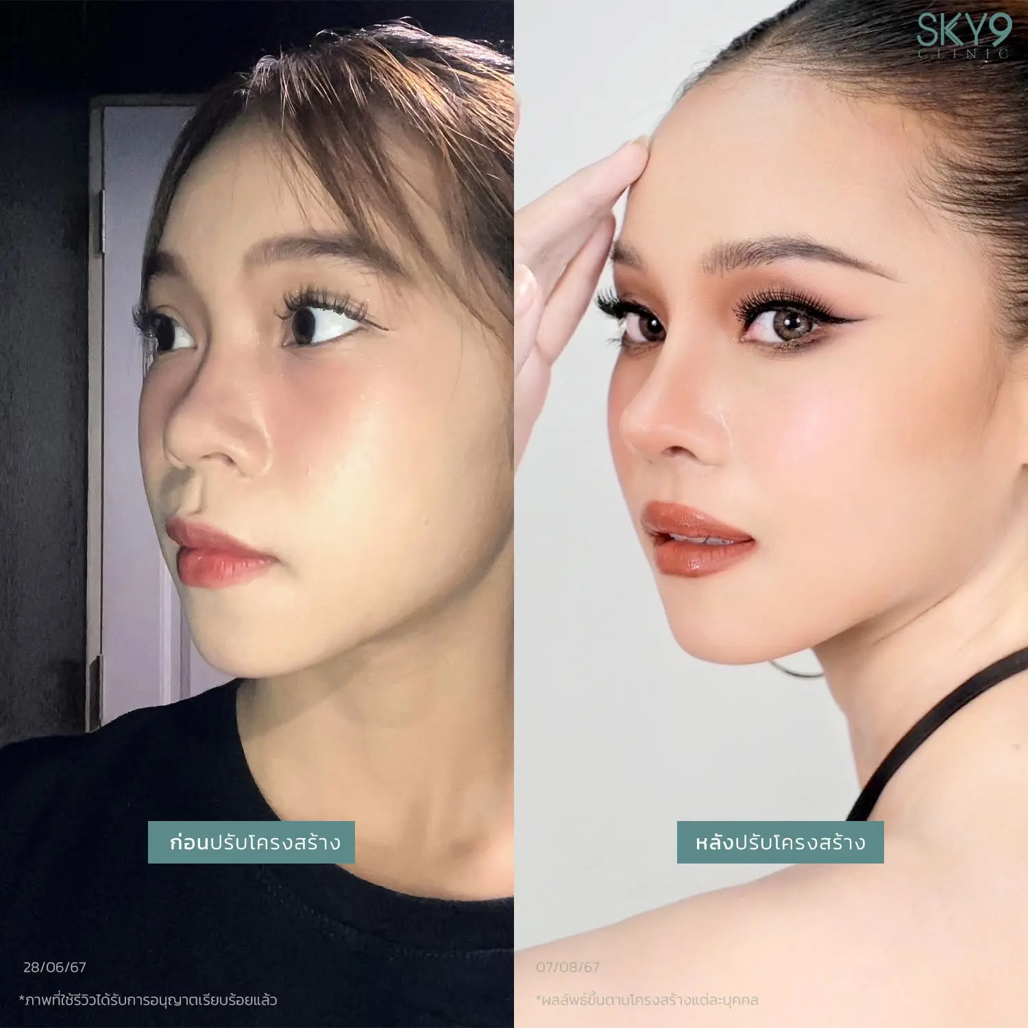 รีวิวเสริมจมูก 53