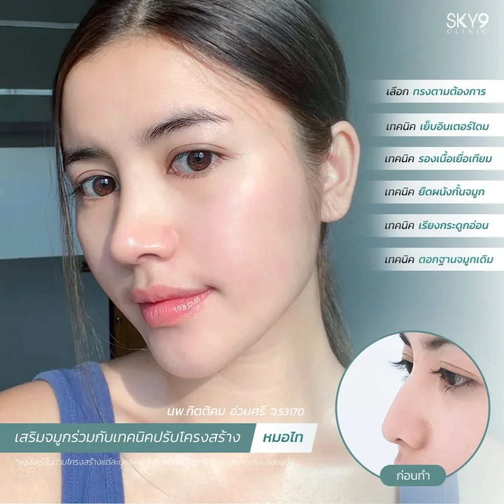 รีวิวเสริมจมูก 54