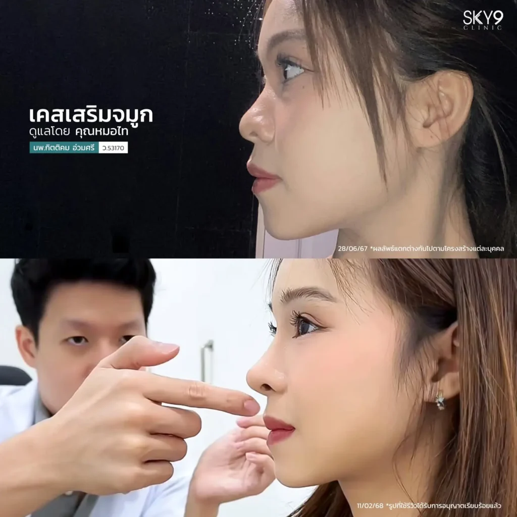รีวิวเสริมจมูก 56