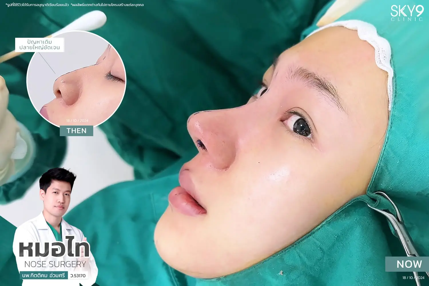 รีวิวเสริมจมูก 57