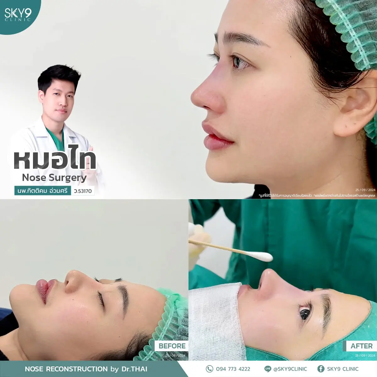 รีวิวเสริมจมูก 61