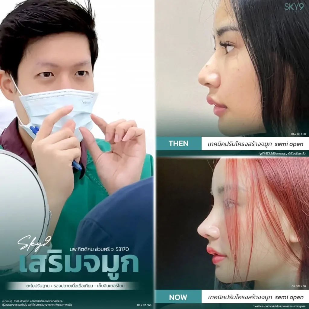 รีวิวเสริมจมูก 62