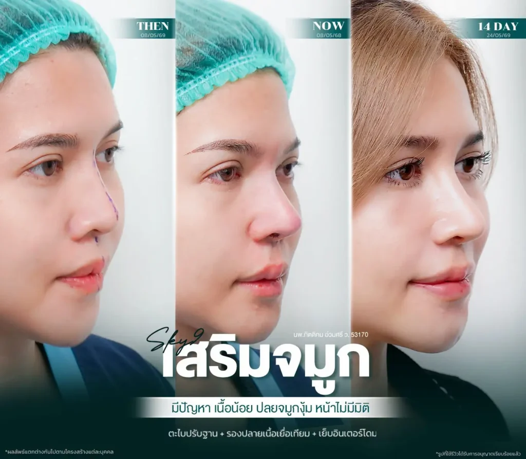 รีวิวเสริมจมูก 64