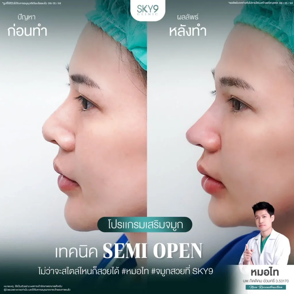 รีวิวเสริมจมูก 65
