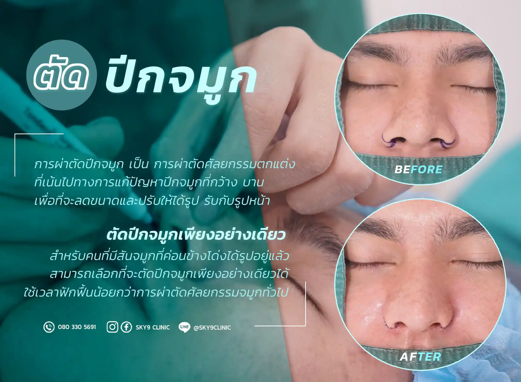 ศัลยกรรมตัดปีกจมูก 01