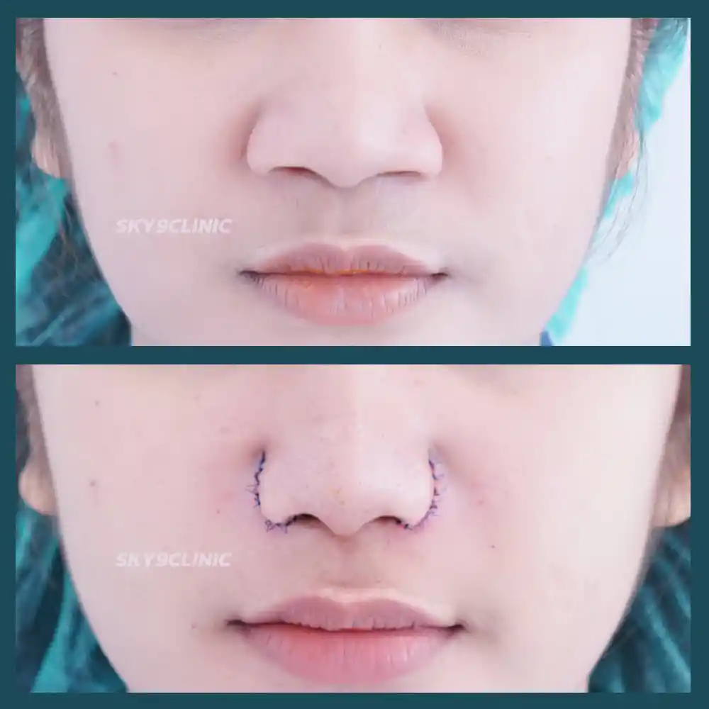 ศัลยกรรมตัดปีกจมูก 04