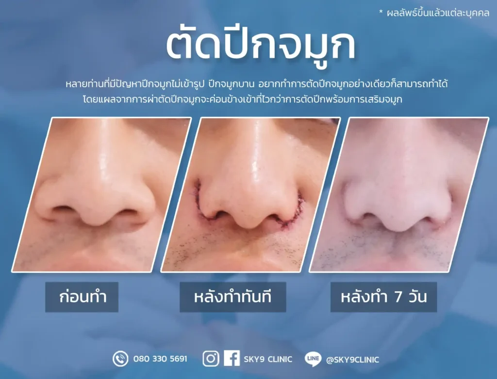 ศัลยกรรมตัดปีกจมูก 07
