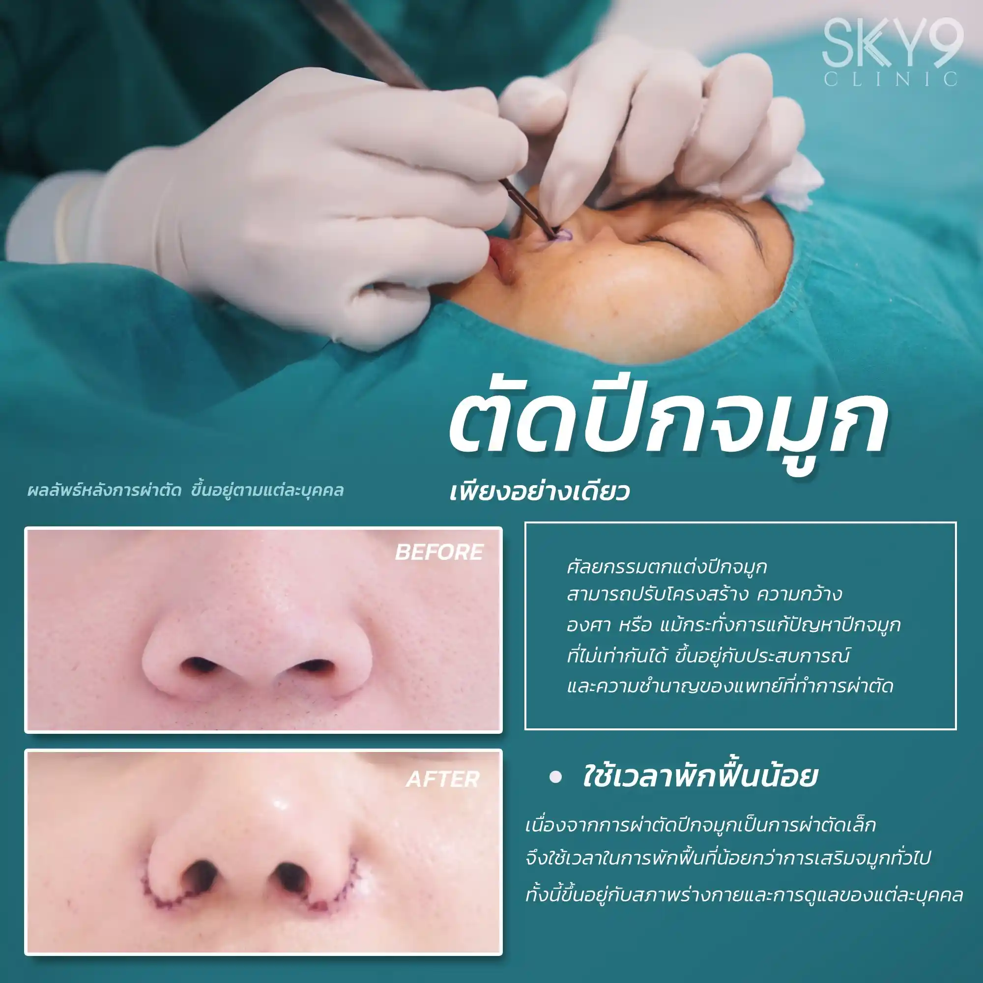 ศัลยกรรมตัดปีกจมูก 08